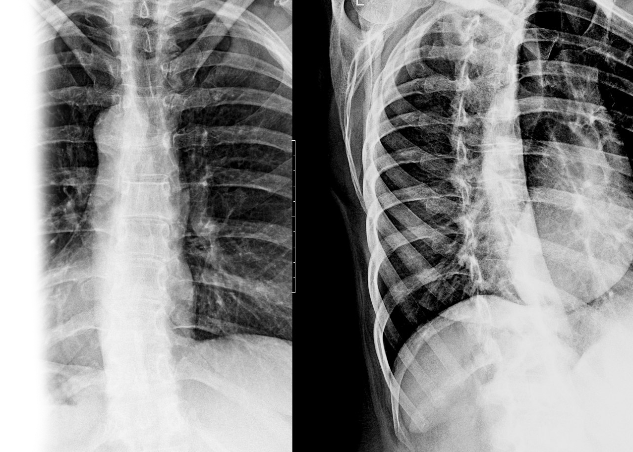 Рентгенография одного отдела позвоночка