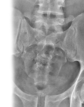 Рентгенография крестцово-подвздошного сочленения