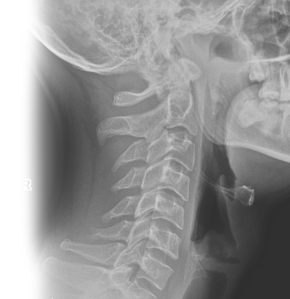 Рентгенография гортани в боковой проекции
