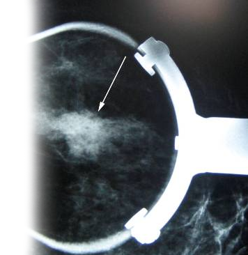 Прицельная маммография