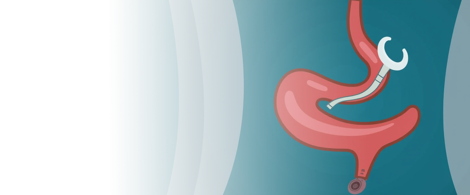 Пилоропластика