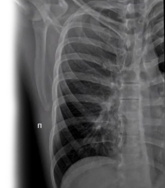 Рентгенография ребер