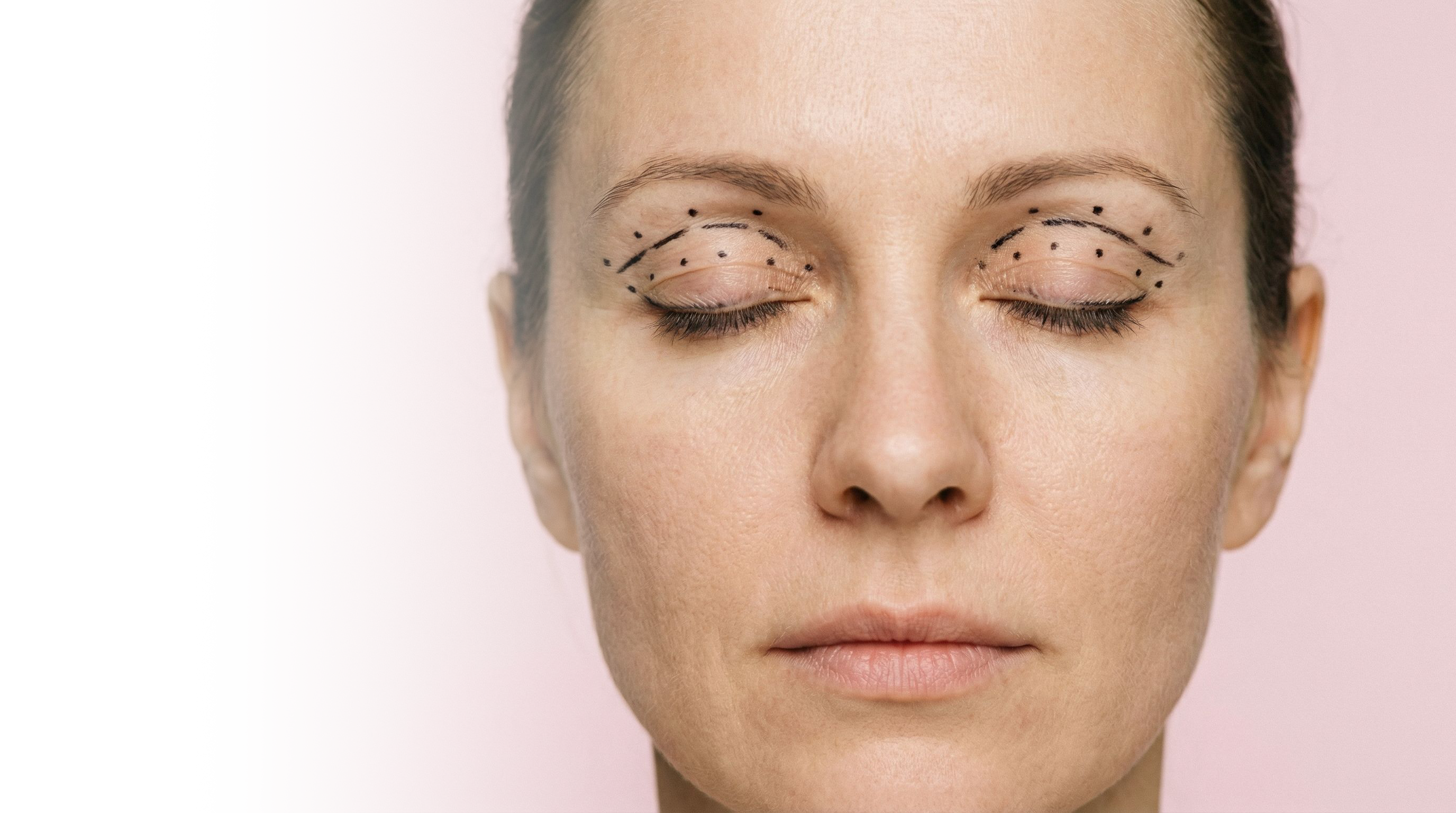 Верхняя блефаропластика «под ключ» со скидкой 20%