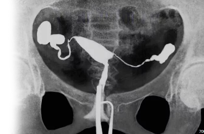 Гистеросальпинография