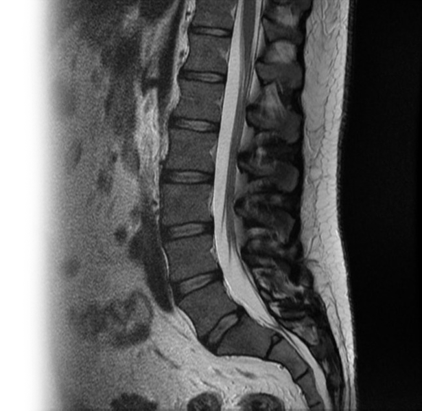 МРТ 1 отдела позвоночника с контрастом