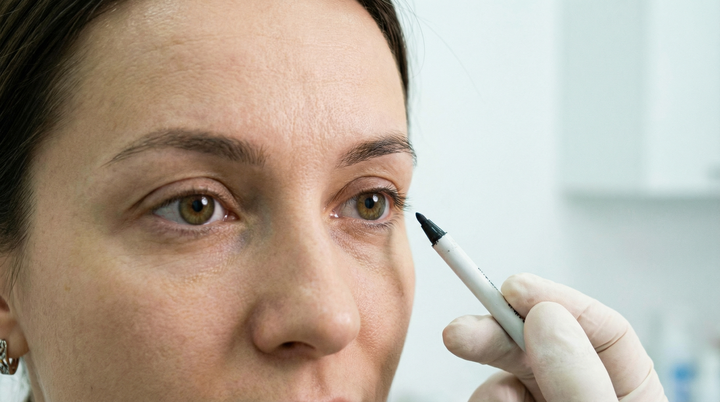 Пластика глаз