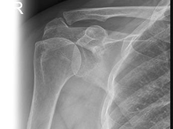 Рентгенография плечевого сустава