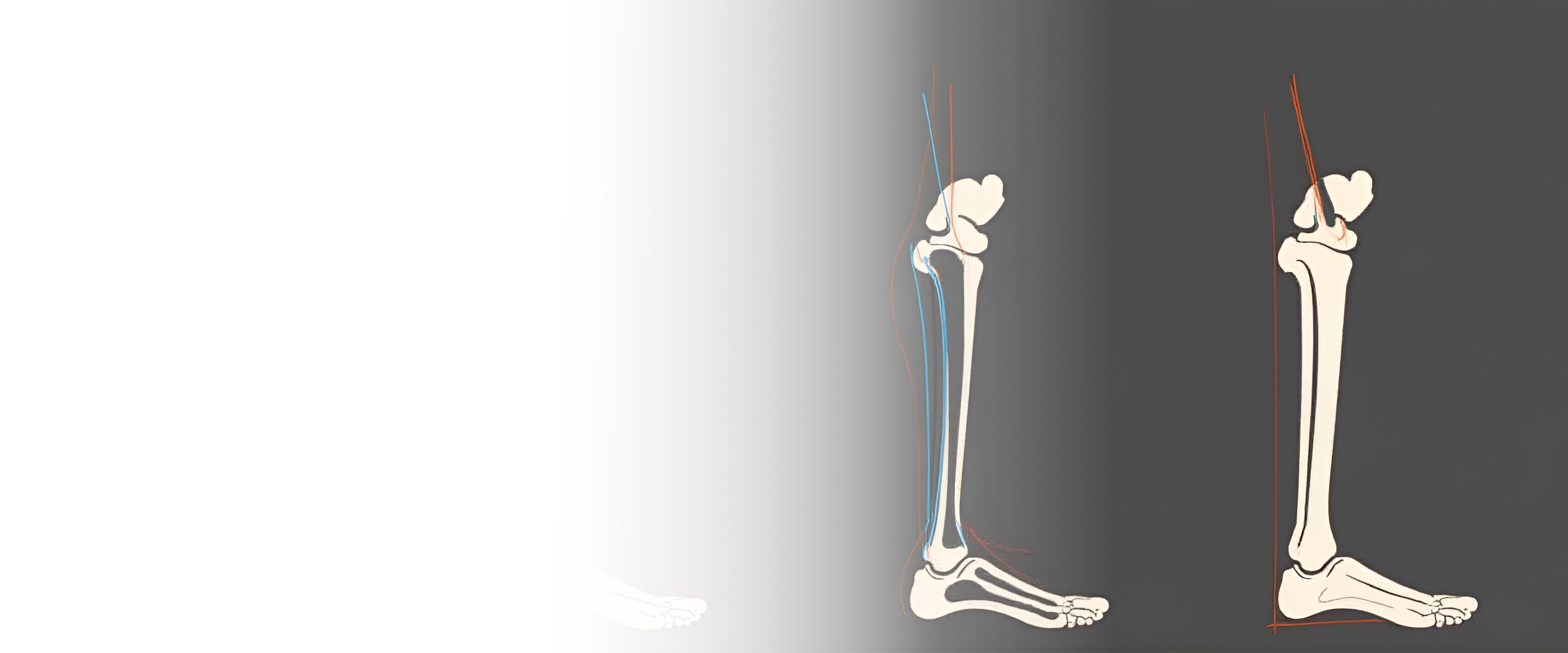 Наложение скелетного вытяжения