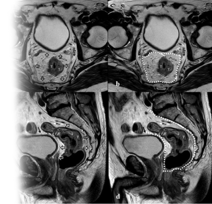 МРТ органов малого таза с прицельным описанием анального канала