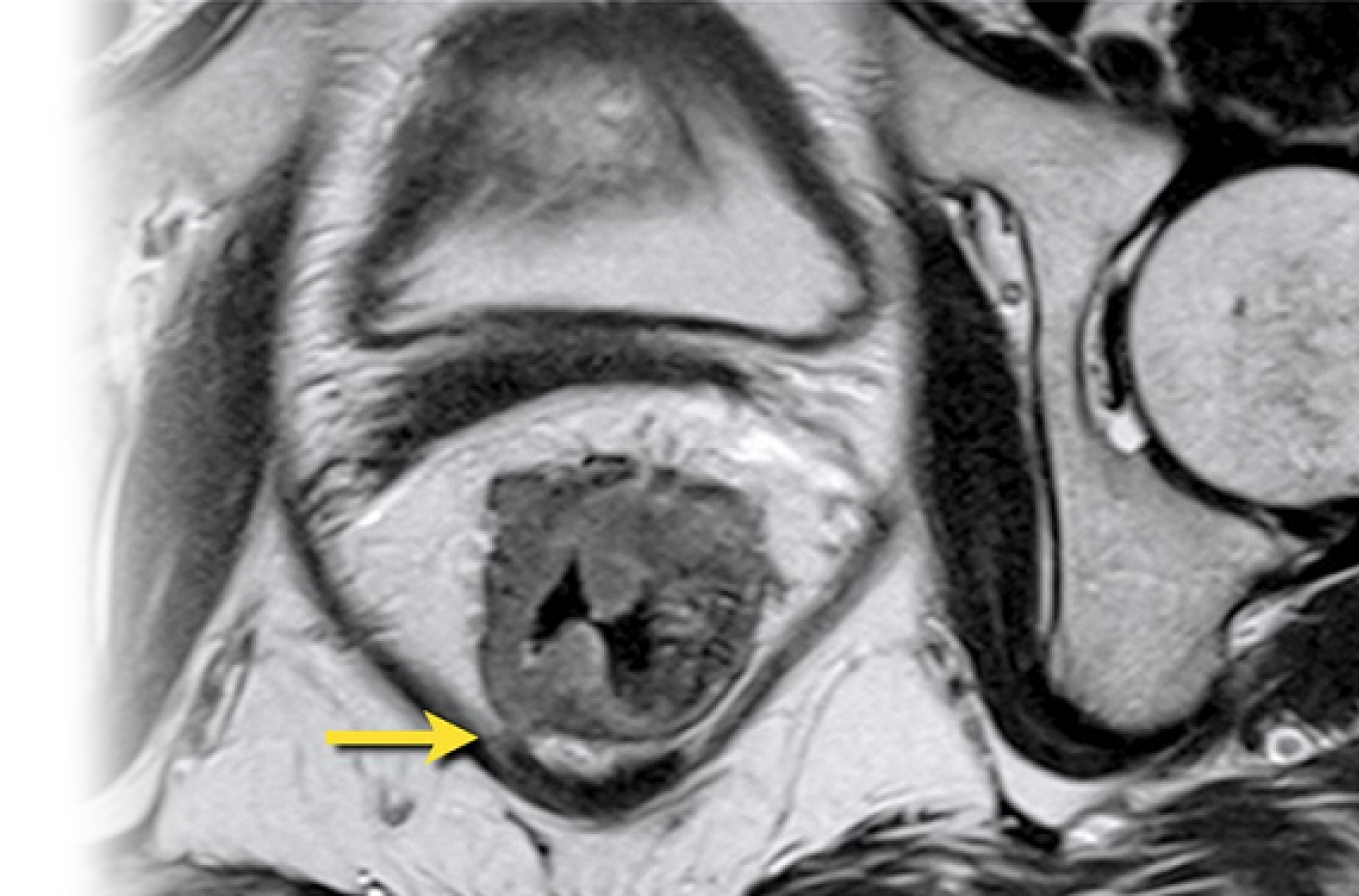 МРТ анального канала с контрастом