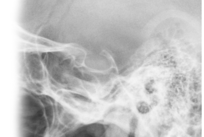 Рентгенография турецкого седла