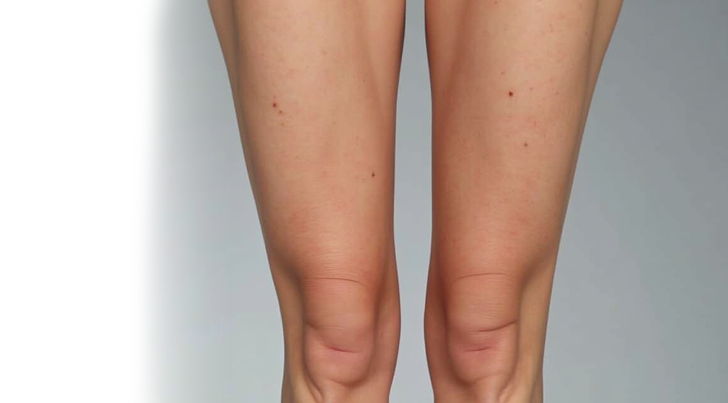 Минифлебэктомия