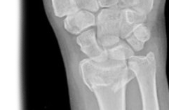 Рентгенография лучезапястного сустава