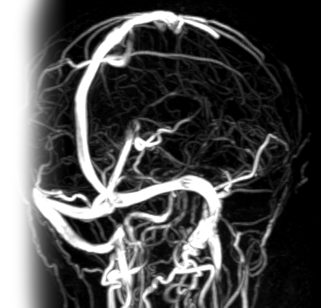 МР бесконтрастная венография интракраниальных вен и синусов