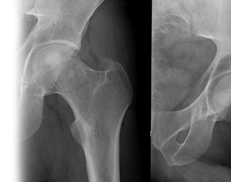 Рентгенография тазобедренного сустава