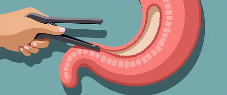 Резекция желудка