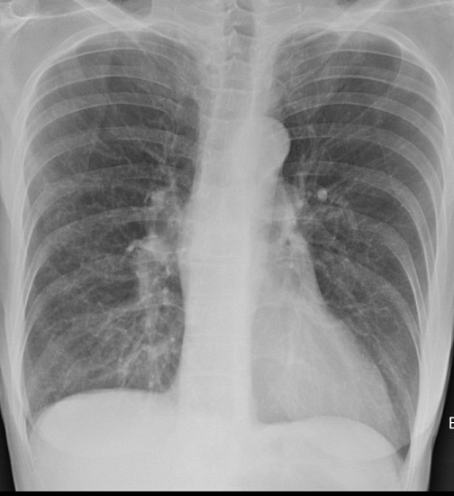 Рентгенография органов грудной клетки