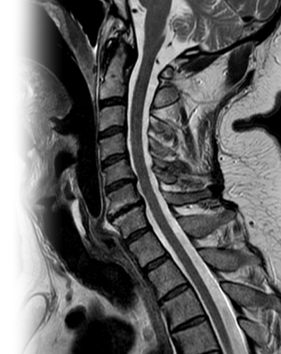 МРТ шейного отдела позвоночника
