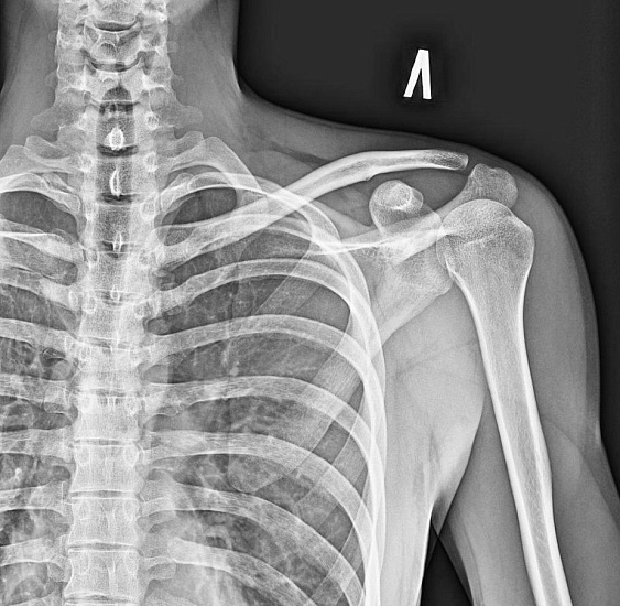 Рентгенография лопатки