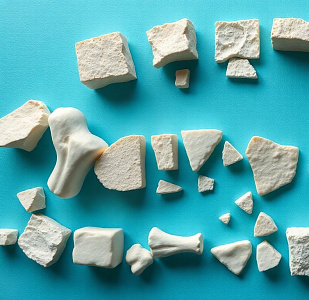 Репозиция костных отломков