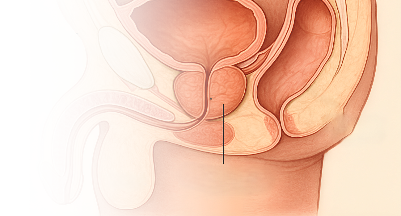 ТУР простаты