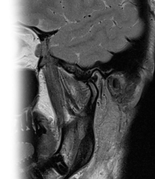МРТ височно-нижнечелюстных суставов