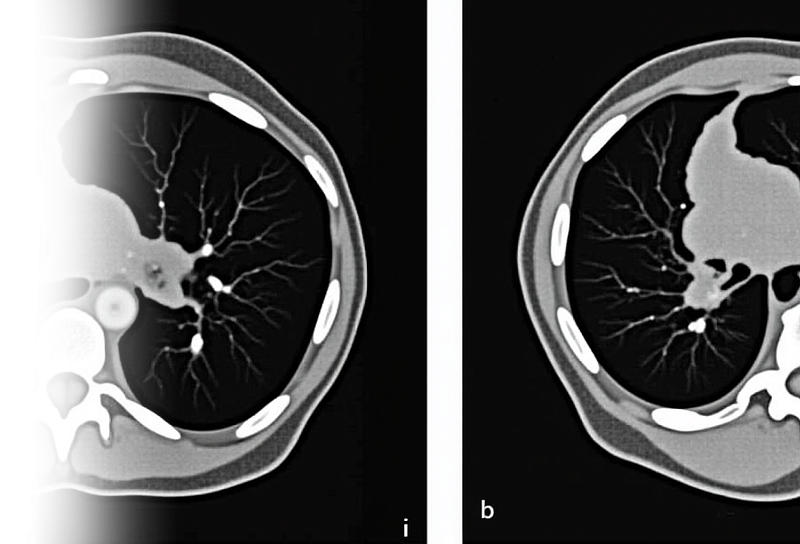 КТ органов грудной клетки