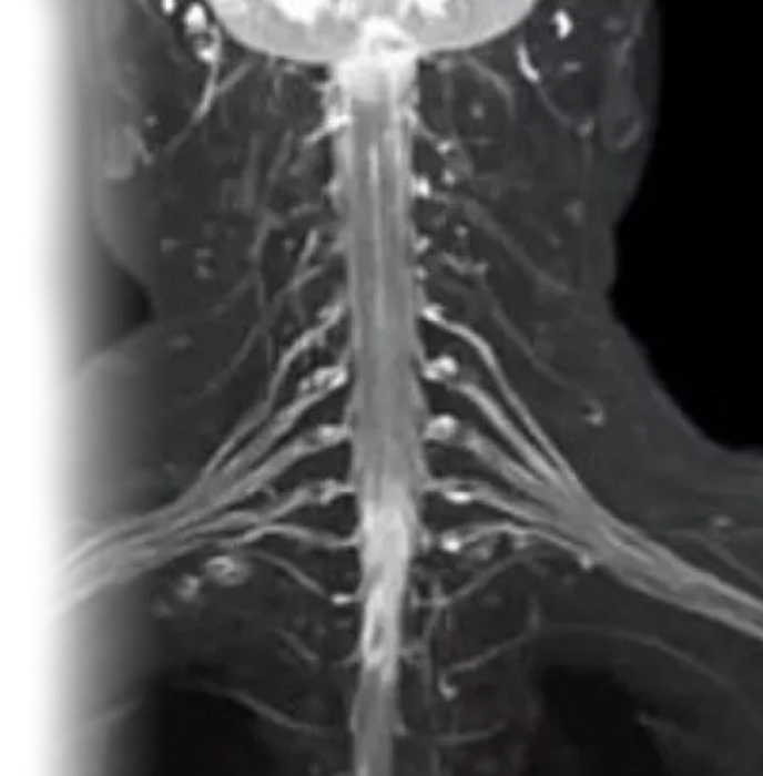 МРТ плечевого сустава
