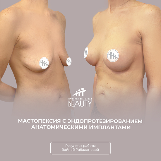 Примеры работ пластического хирурга Рабадановой З.М.