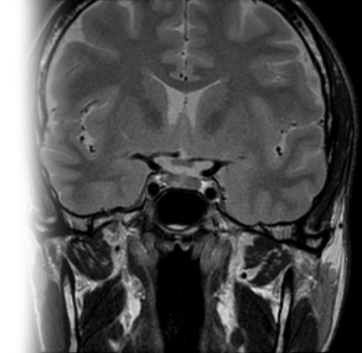 МРТ гипофиза