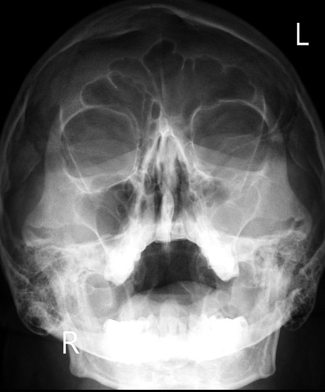 Рентгенография придаточных пазух носа