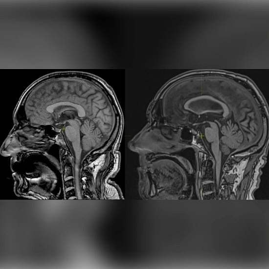 Что можно увидеть на МРТ головного мозга?