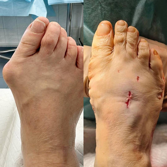 Продуваемые ветром пальцы ног