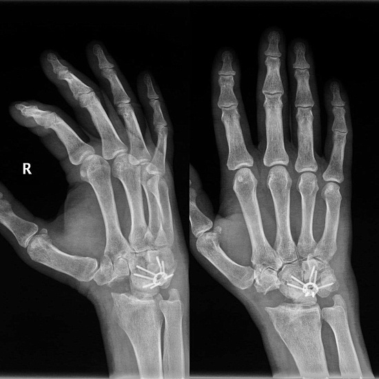 Что будет, если долго не лечить перелом?