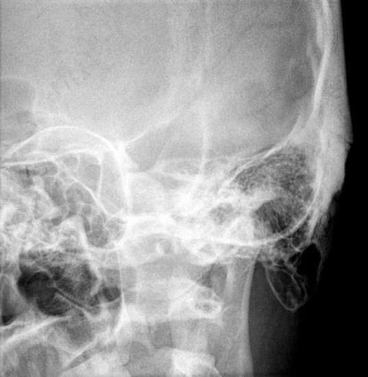 Рентгенография сосцевидных отростков