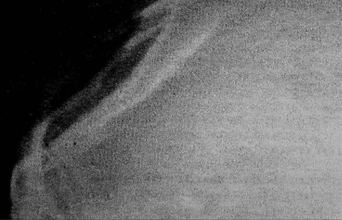 Рентгенография черепа