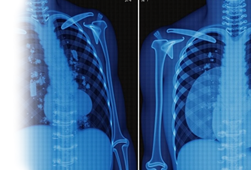 КТ органов грудной клетки с виртуальной бронхоскопией