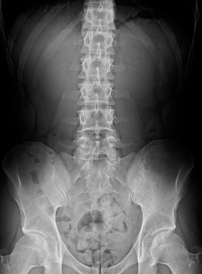 Рентгенография пояснично-крестцового отдела позвоночника