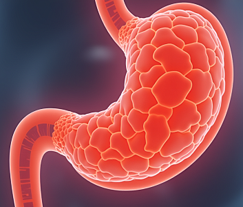 Ушивание язвы желудка и 12-перстной кишки