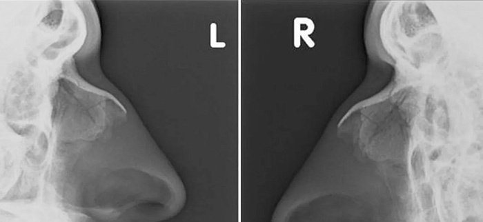 Рентгенография костей носа