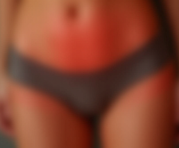 Вылущивание кисты бартолиновой железы