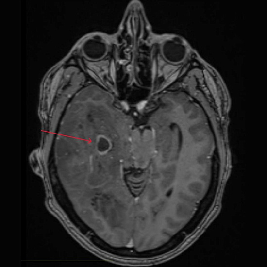 Нарушение зрения на правый глаз и частая головная боль