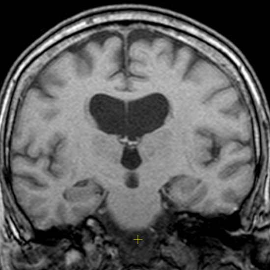 Скованная шаткость
