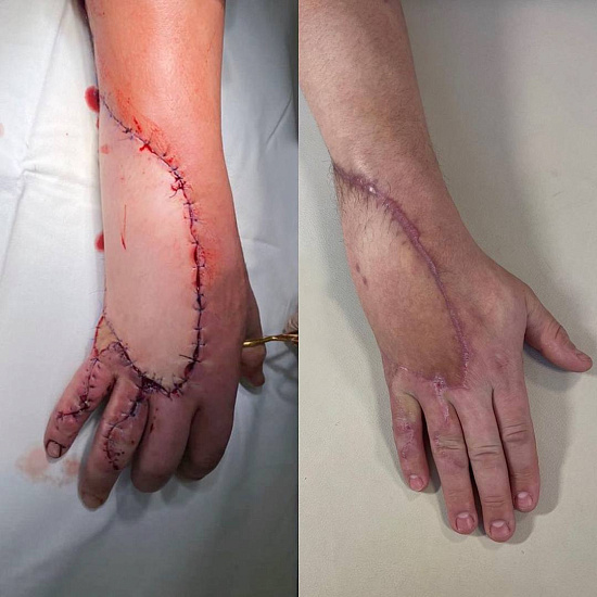 Травма кисти об забор