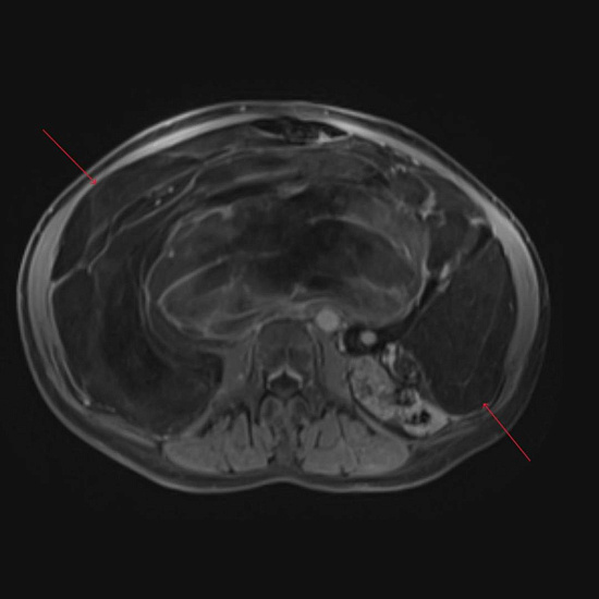 Живот растет, а вес уходит