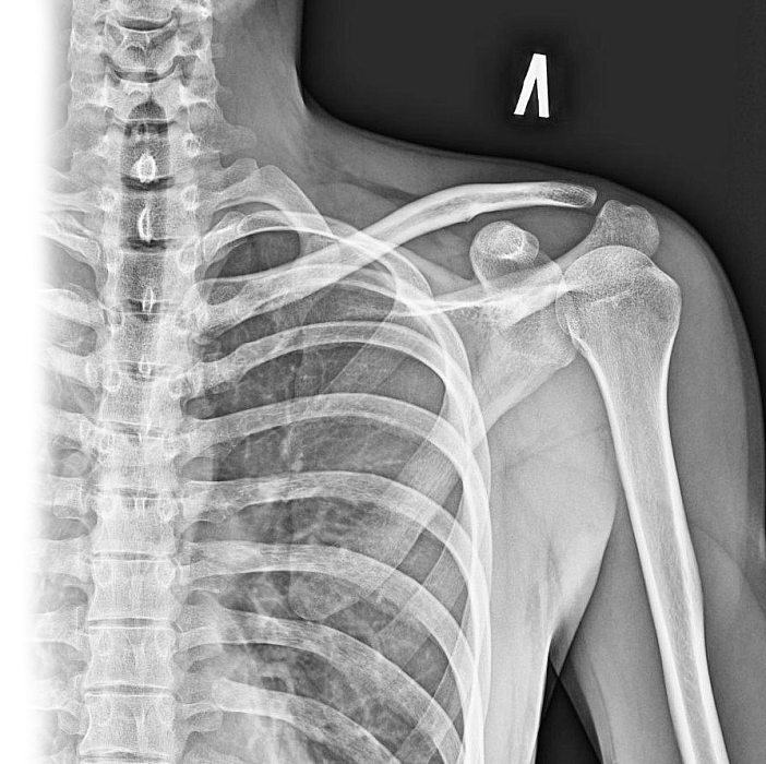 Рентгенография лопатки
