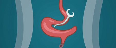 Пилоропластика