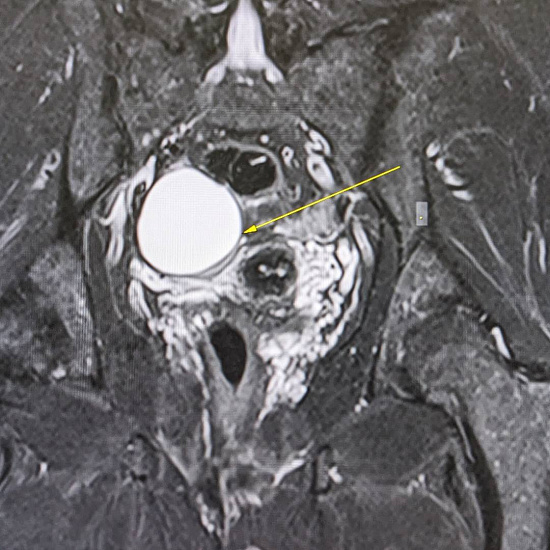 Цистаденома