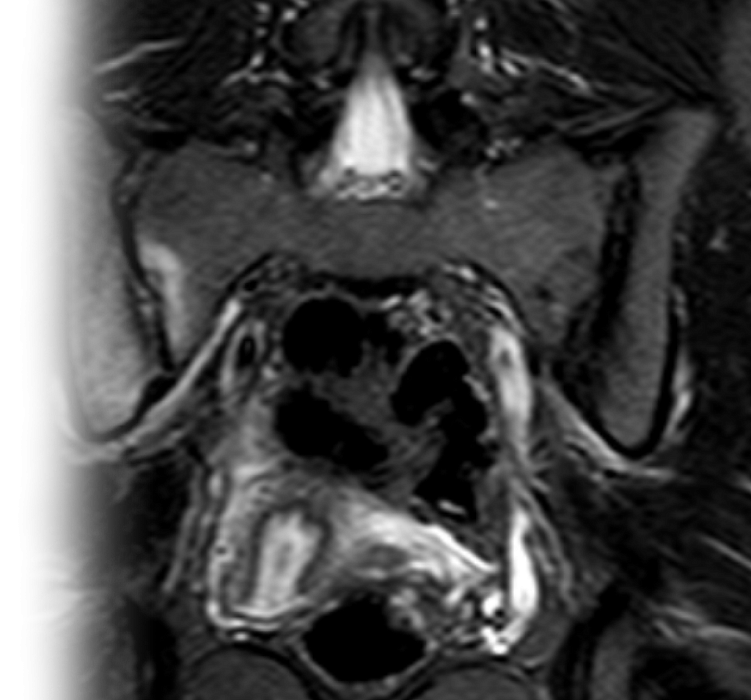 МРТ крестцово-подвздошных сочленений