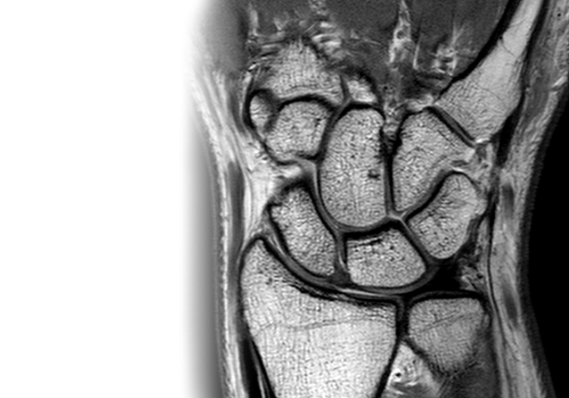 МРТ лучезапястного сустава